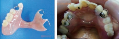 写真３　部分義歯と口腔内で装着した状態