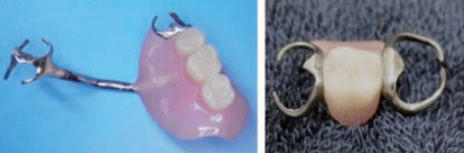 写真４　上顎の３本欠損の部分義歯　１本欠損の部分義歯