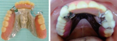 写真１　総義歯