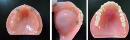 写真３　部分義歯と口腔内で装着した状態
