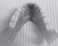 歯石が沈着した義歯