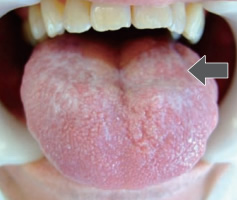 舌の扁平苔癬