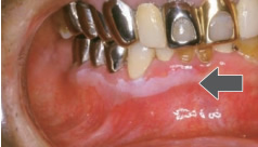 下顎の歯肉の白板症