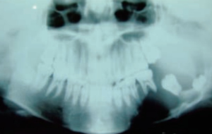 左下顎の良性腫瘍像