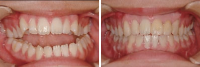 顎変形症によって奥歯しか噛み合わず、前歯部では全く食物を噛みきれない状態でした