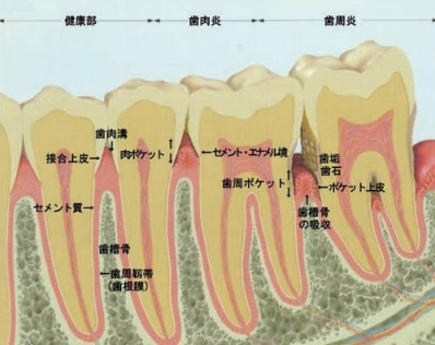 歯の断面図と歯周病
