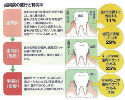 歯周病の進行と有病率