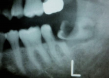左下顎の良性腫瘍像